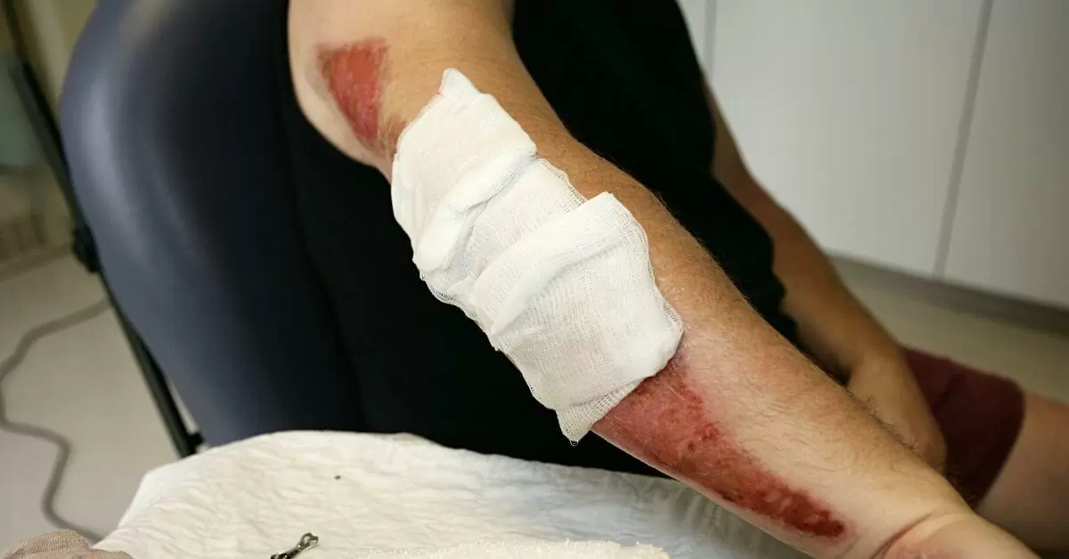 Motorcycle Accident Injuries and Road Rash