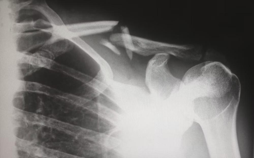 shoulder-injury-case Factors Impact the Value of a Shoulder Injury Case